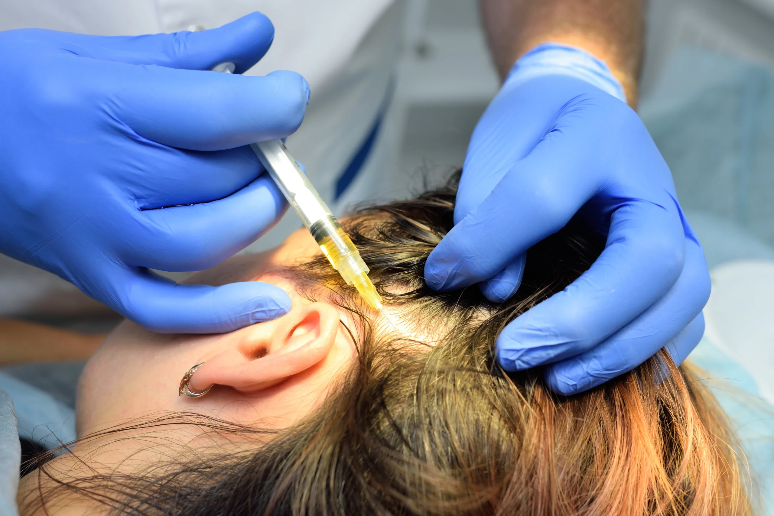 Natural Growth Factor injection being injected on hair scalp | Century Medical Services | Forest Hills, NY